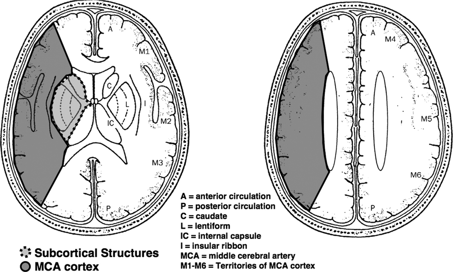 Aspects Score For Acute Strokes