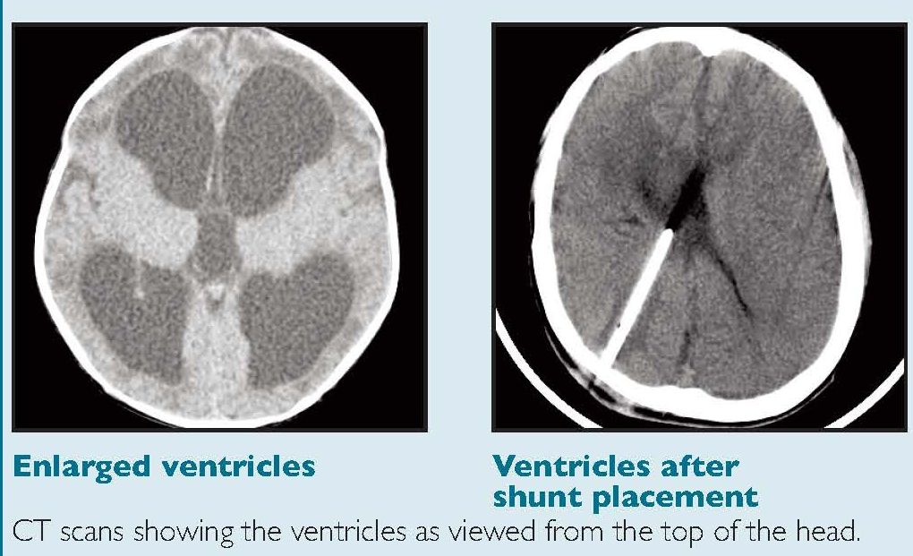 VP shunt placement for hydrocephalus after posterior fossa